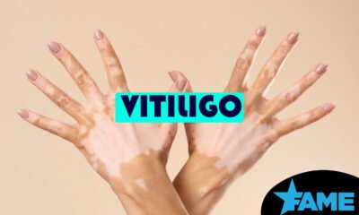Vitiligo