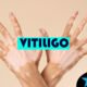 Vitiligo
