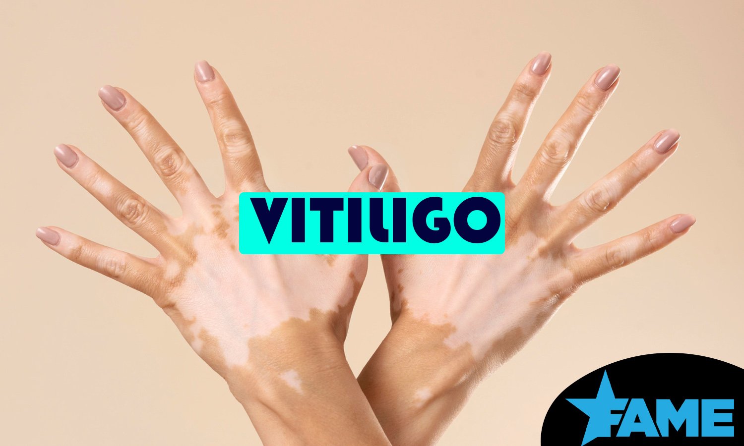 Vitiligo